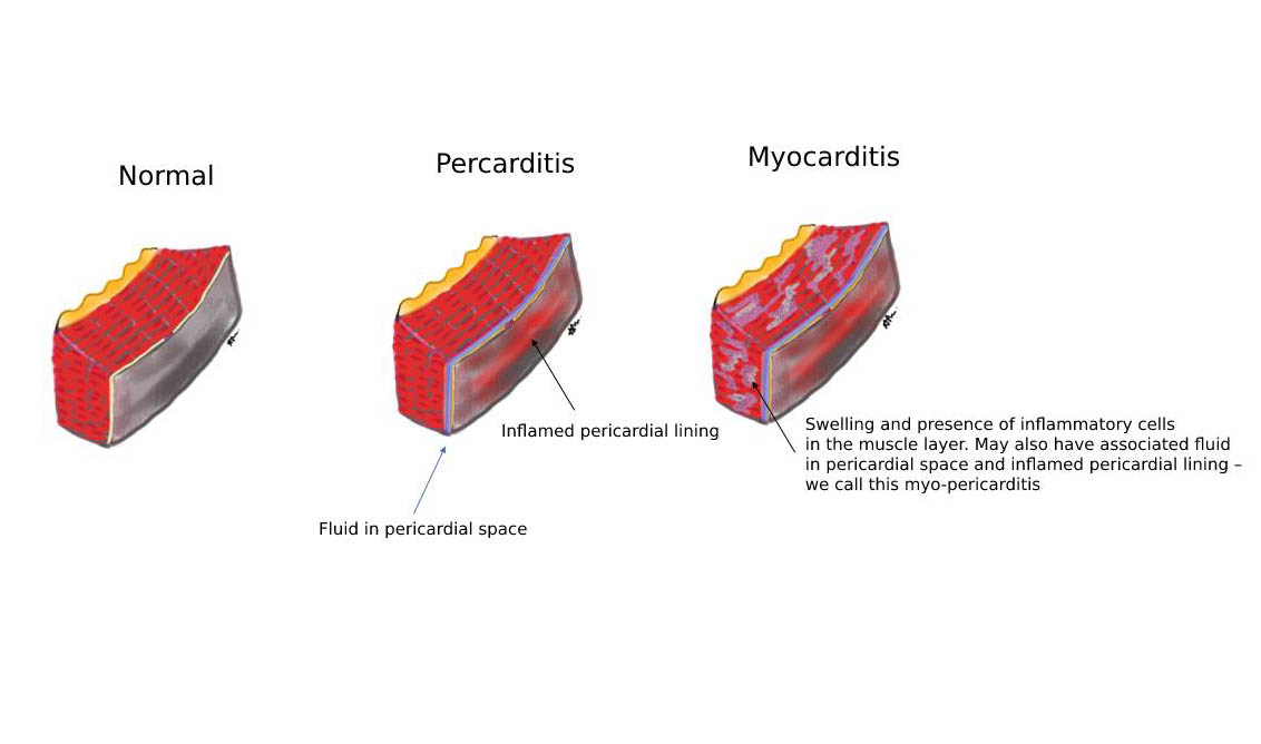 Learning More About Myocarditis And Pericarditis