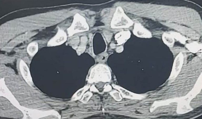 Type A Aortic Dissection
