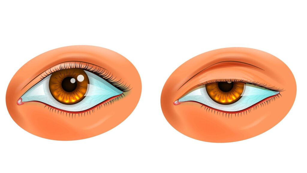 Ptosis of the Upper Eyelids – Medicus Network – Find your medical ...